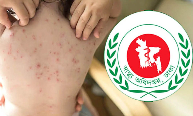 হামে মৃত্যু ৭০০ ছাড়াল, নতুন করে আরও ৪ শিশুর প্রাণহানি